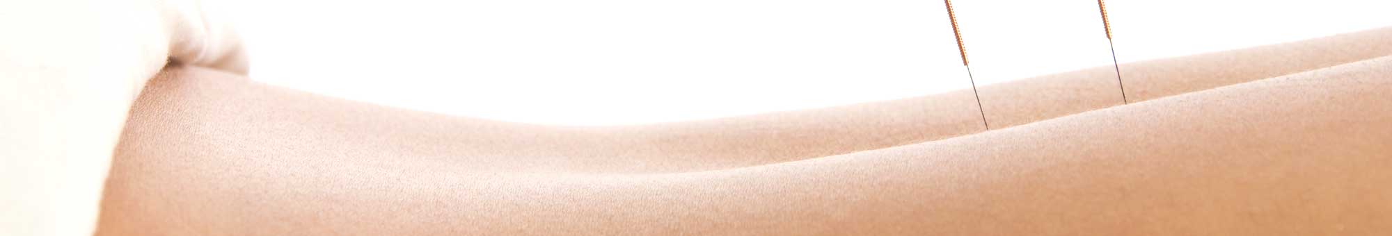 Patient receiving Medical Acupuncture